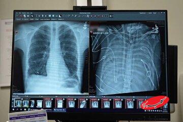 مردی ۴۸ ساعت بدون ریه زنده ماند