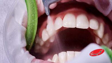 جرمگیری، راهی موثر برای پیشگیری از پوسیدگی و بیماری لثه