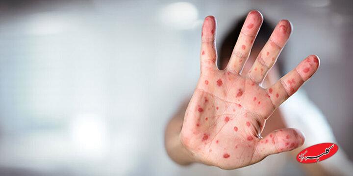 موج سرخک در بنگلادش جان ۵۰۰ کودک را گرفت