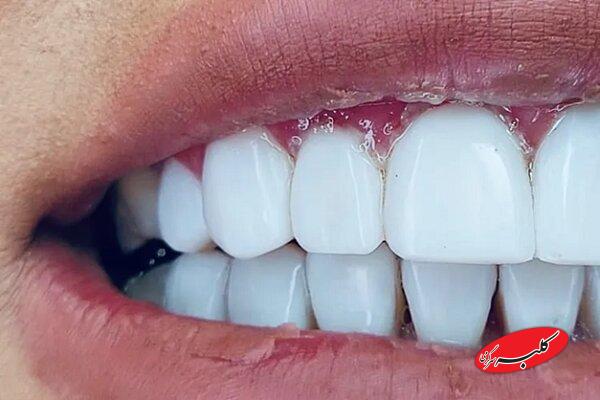 نگرانیهای دندانپزشکی در بارداری