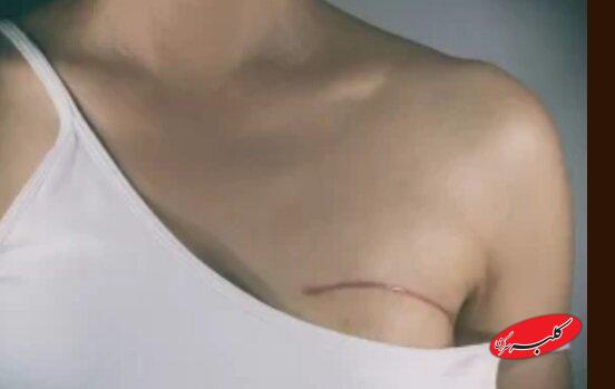 کاهش وزن چه ارتباطی با سرطان سینه دارد؟