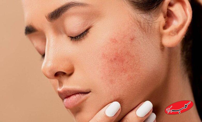 برای رفع خشکی پوست چه خوراکیهایی بخوریم؟