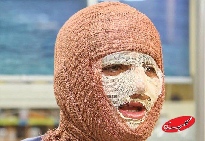 «جان نو» به کمک بیماران سوختگی میآید