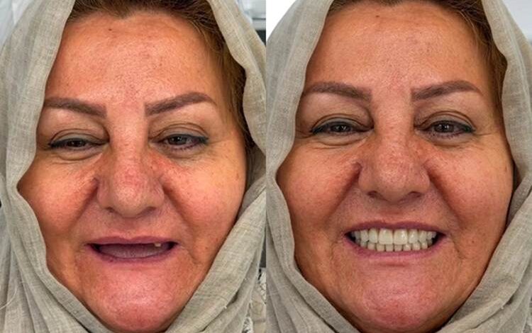 اوردنچر فول