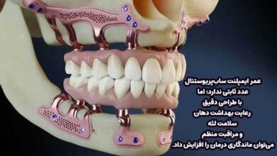 ایمپلنت های ساب پریوستئال چقدر عمر میکنند؟