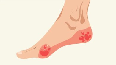 زخم پای دیابتی